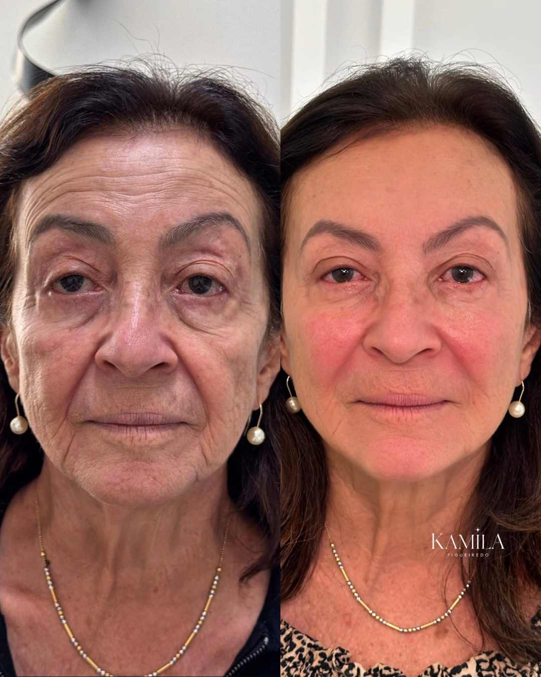 Resultado de rejuvenescimento facial — caso 1