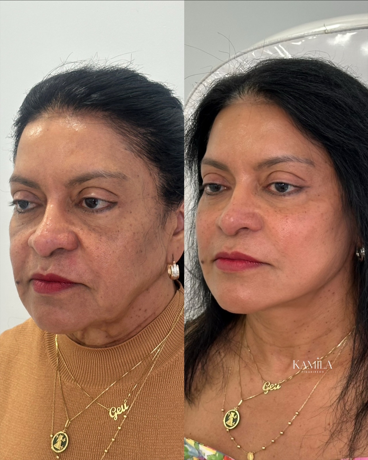 Resultado de rejuvenescimento facial — caso 2