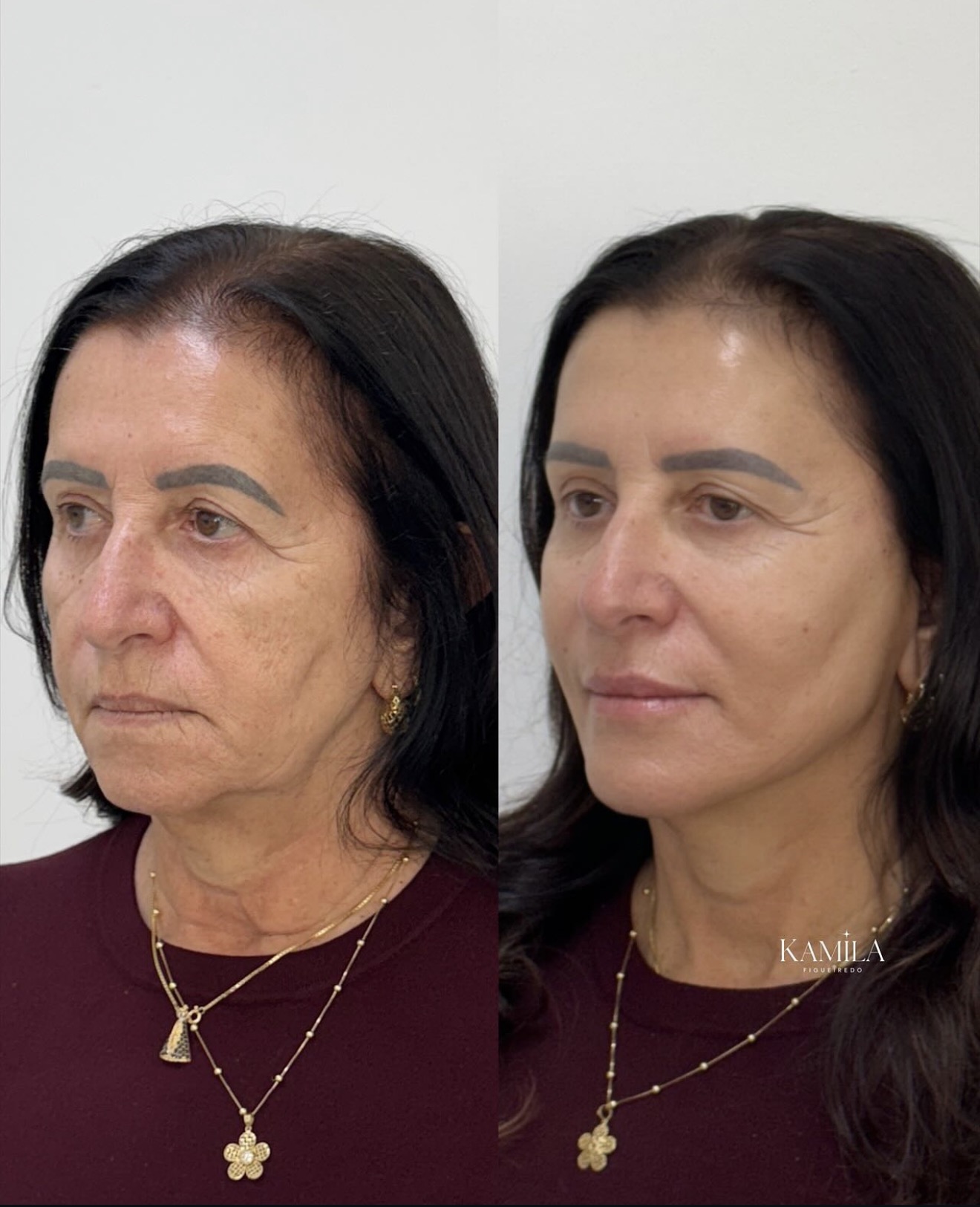 Resultado de rejuvenescimento facial — caso 3